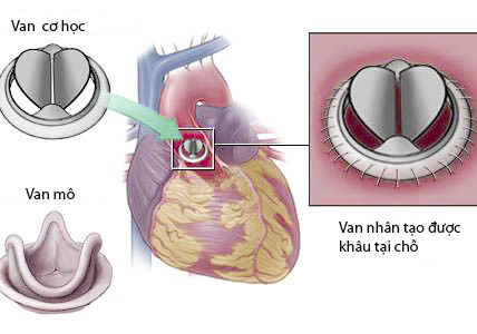 Quảng Ninh: Lần đầu tiên áp dụng kỹ thuật tiêu sợi huyết cứu sống người bệnh bị kẹt van tim nhân tạo